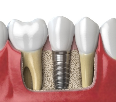 Illustrated dental implant fused with the jawbone