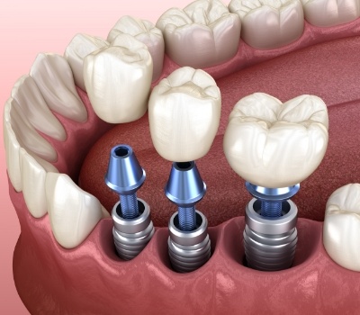 Illustration of three dental crowns being fitted onto three dental implants