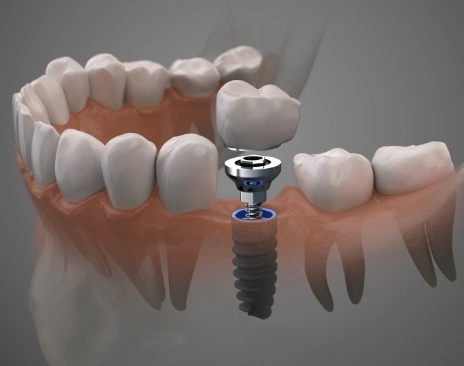 Illustration of dental crown being fitted over a dental implant