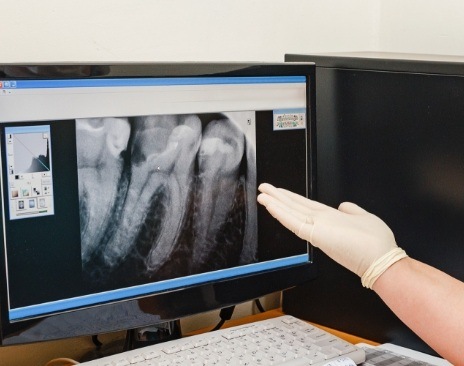 Dentist gesturing to computer monitor with x ray of teeth