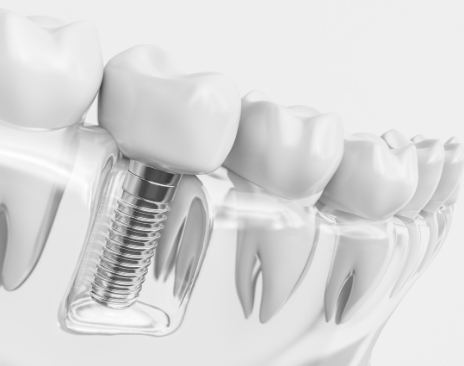 Illustration of dental implant replacing a missing lower tooth
