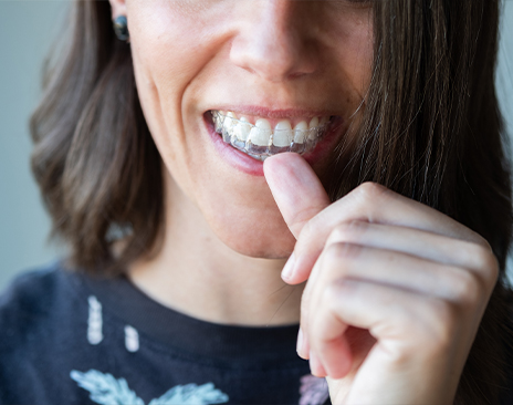 Woman placing a Sure Smile clear aligner over her teeth