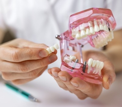 Dentist holding a dental bridge and a model of the mouth with dental implants
