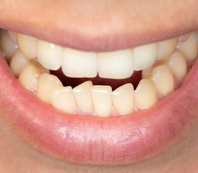 Closeup of a smile with an overcrowded lower arch