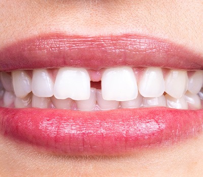 Closeup of a woman’s mouth with gap between two front teeth