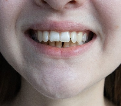 Nose-to-neck closeup of woman with more severe overbite smiling