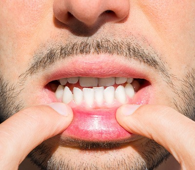 Nose-to-chin closeup of man pulling down lower lip with 2 fingers to reveal underbite
