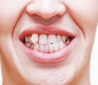 Nose-to-neck view of someone showing off their crossbite