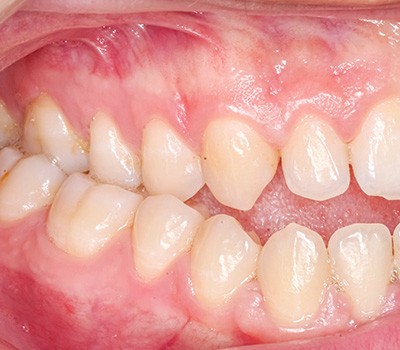 Closeup of a mouth with molars touching and slight open bite in front teeth