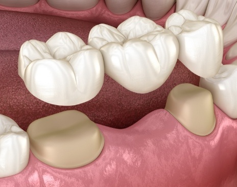 Illustrated dental bridge replacing a missing tooth