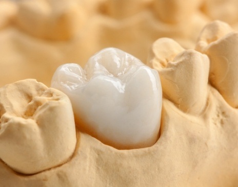 Dental crown covering a tooth in a model of the mouth