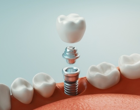 Illustrated dental implant with abutment and crown being placed in lower jaw