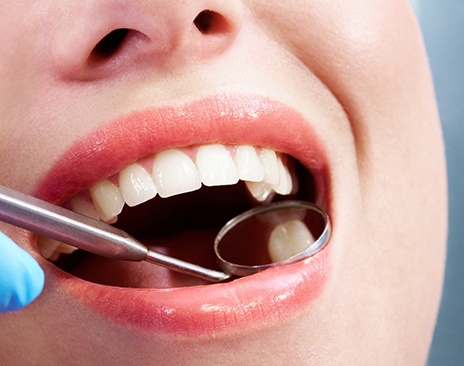 Closeup of a dental mirror reflecting woman’s tooth