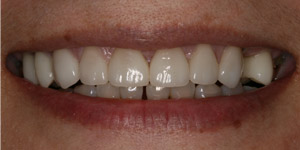 Closeup of flawless smile after cosmetic treatment