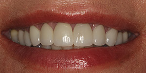 Closeup of flawless smile after cosmetic treatment
