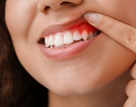 Person pointing to red spot in their gums