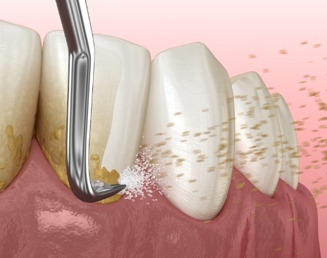 Illustrated dental scaler clearing plaque buildup from teeth