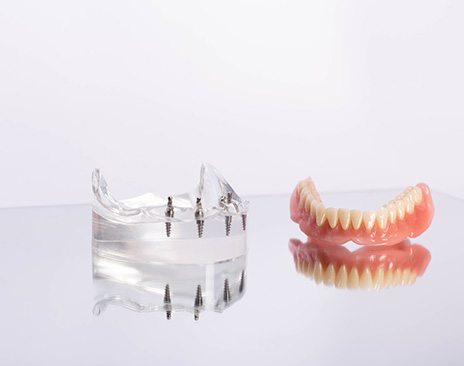 a model of implant dentures 