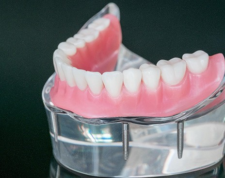 a close-up of fixed implant dentures