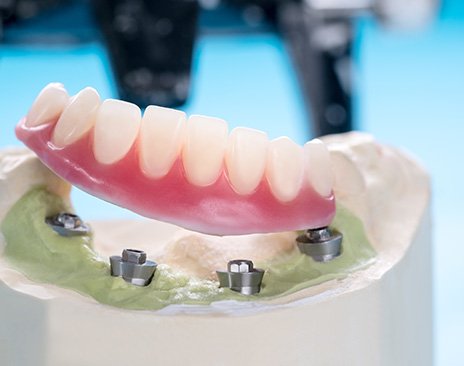 a close-up of removable implant dentures