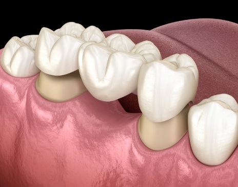 Illustrated dental bridge being fitted onto two natural teeth