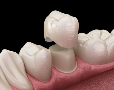 Illustrated dental crown being fitted over a tooth