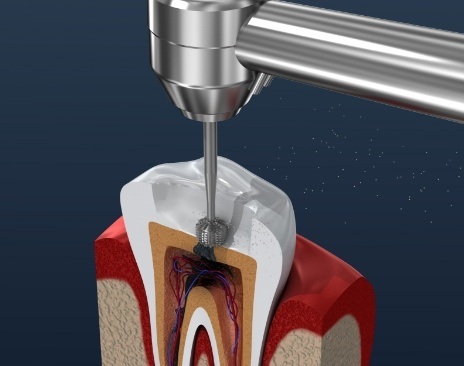 Illustrated dental instrument treating the inside of a tooth