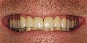Smile after treating yellowed and damaged teeth