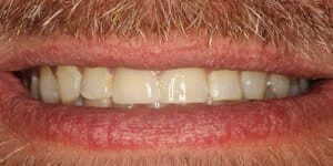 Smile after restoring damaged front tooth