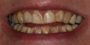 Smile with multiple discolored teeth