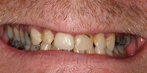 Smile with yellowed and damaged teeth
