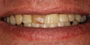 Smile with a damaged front tooth