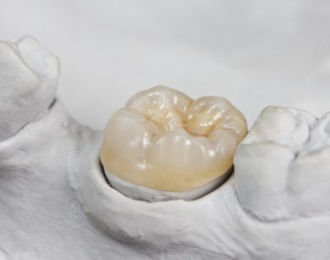 Dental crown covering a tooth in a model of the mouth