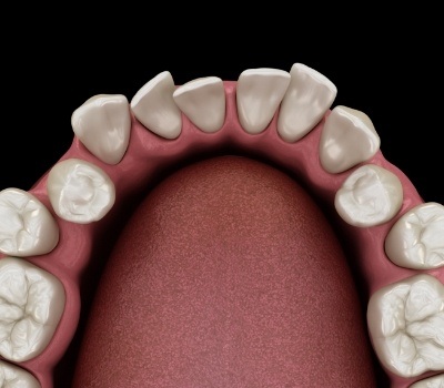 Illustrated row of crowded teeth