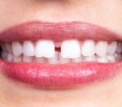 Woman’s smile with gap between the front teeth