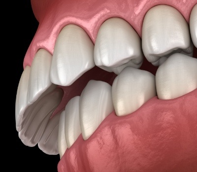 Side view illustration of an overbite