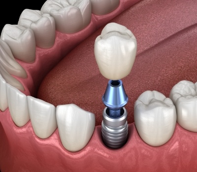 Illustrated dental crown being placed onto a dental implant