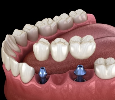 Illustrated dental bridge being placed onto two dental implants