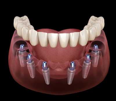 Illustrated full denture being placed onto six dental implants