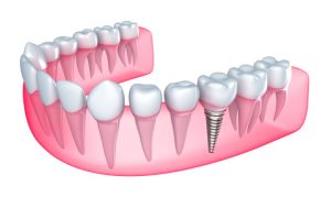 For dental implants, Hillsboro dentist recommends proper cleaning. 