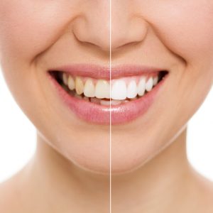 ant a brighter smile? Try KöR teeth whitening from The Dentists at Orenco Station – you’ll be amazed by the dramatic results! 