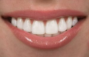 person with veneers smiling