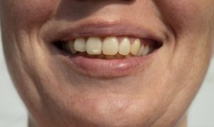 person smiling with white spots on their teeth