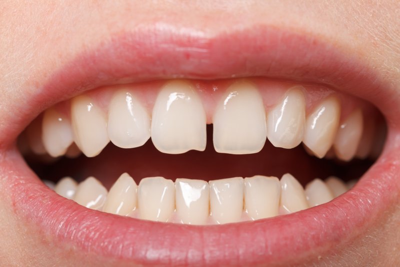 Gap between the front teeth