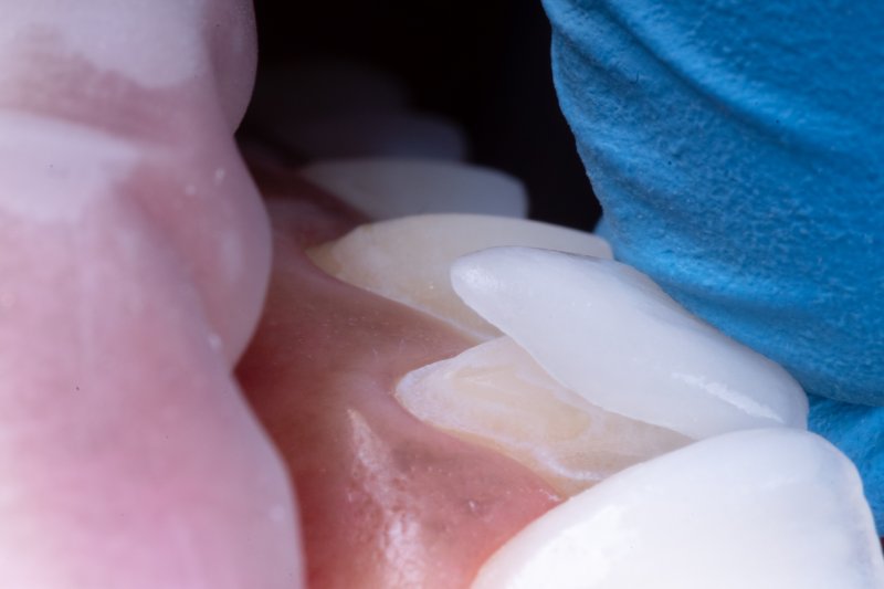 A dentist placing veneers on a patient’s teeth
